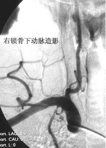 五、锁骨下动脉